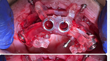 Intraoperative surgical guide — stackable system top view